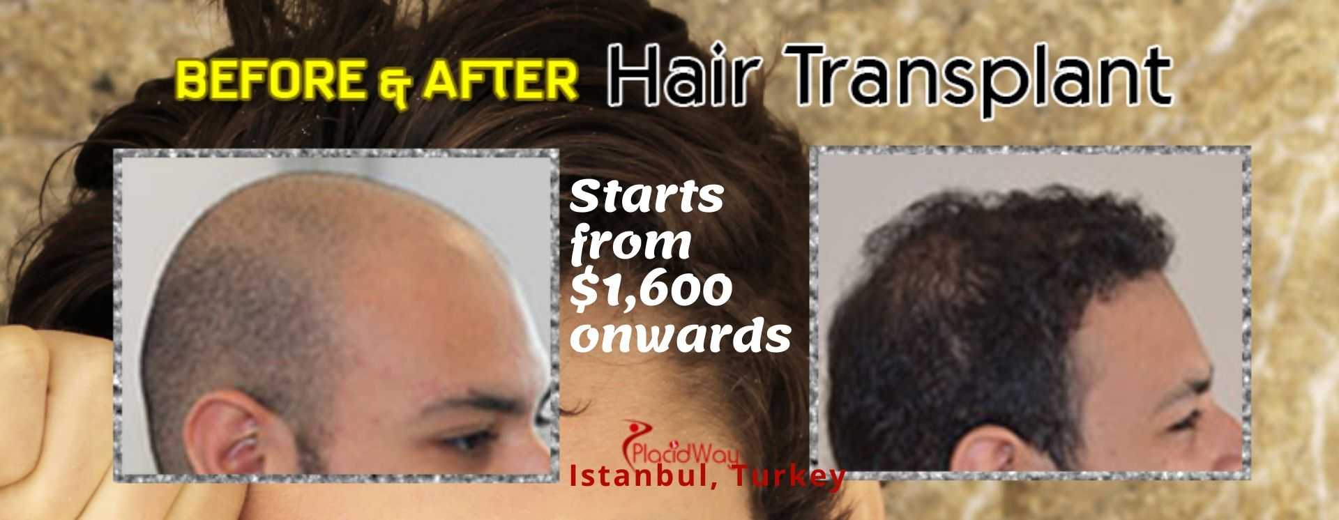 Hair Transplant in Istanbul, Turkey